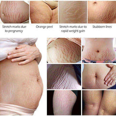 Crocodile Stretch Marks Remover Body Repair Cream