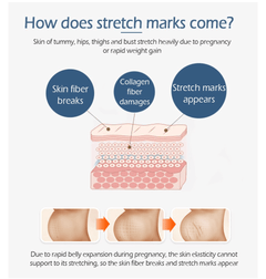 Crocodile Stretch Marks Remover Body Repair Cream